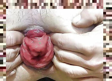 Anal prolapse pump 